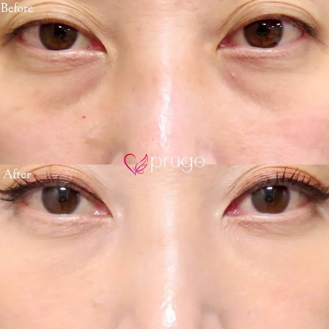 PRP-MI脱脂術（目の下）