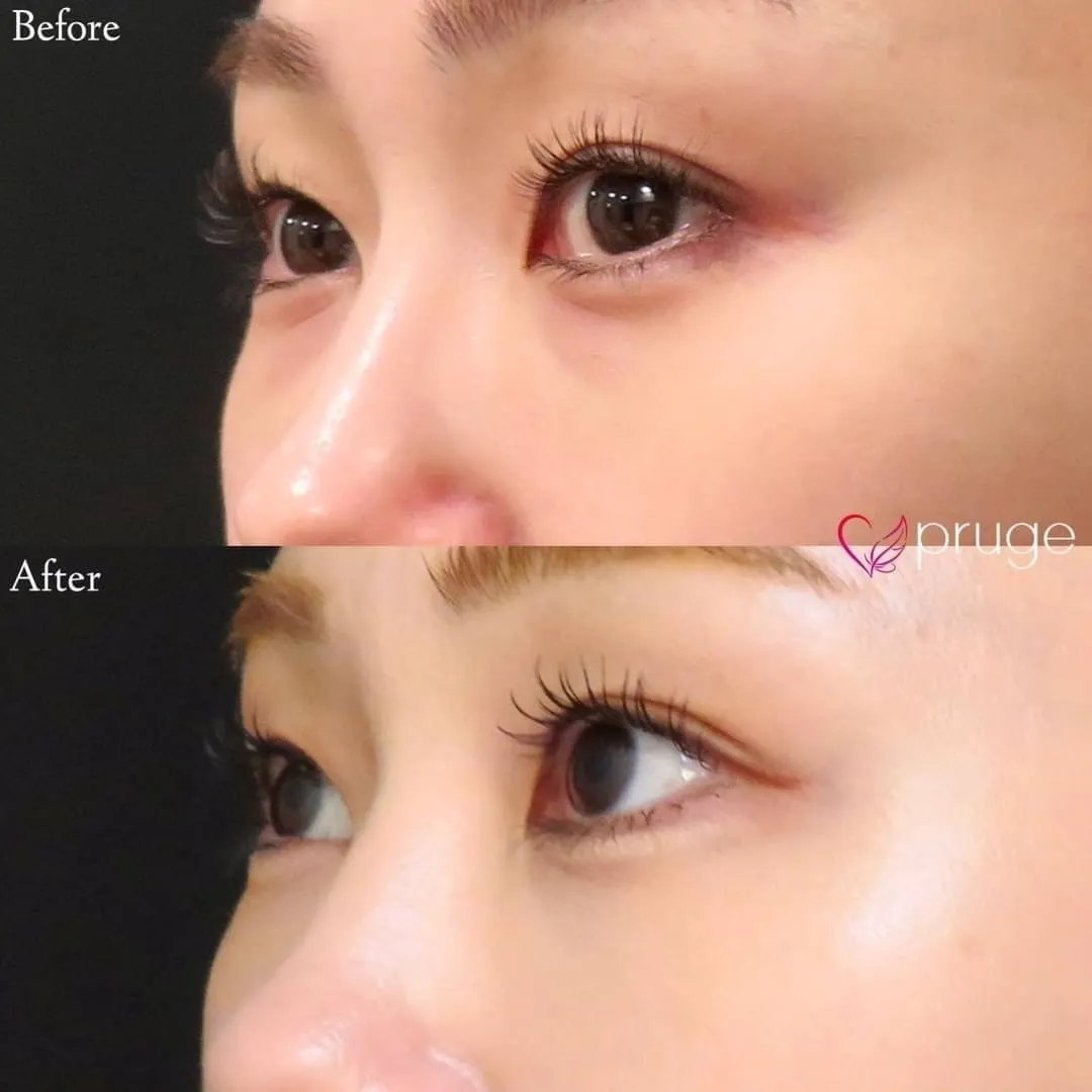 PRP-MI脱脂術（目の下）