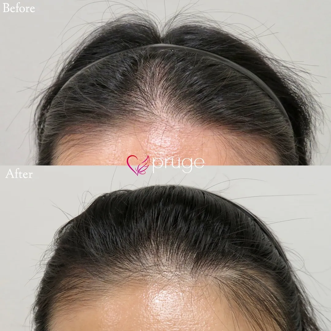 ｐ-スカルプ（1回）