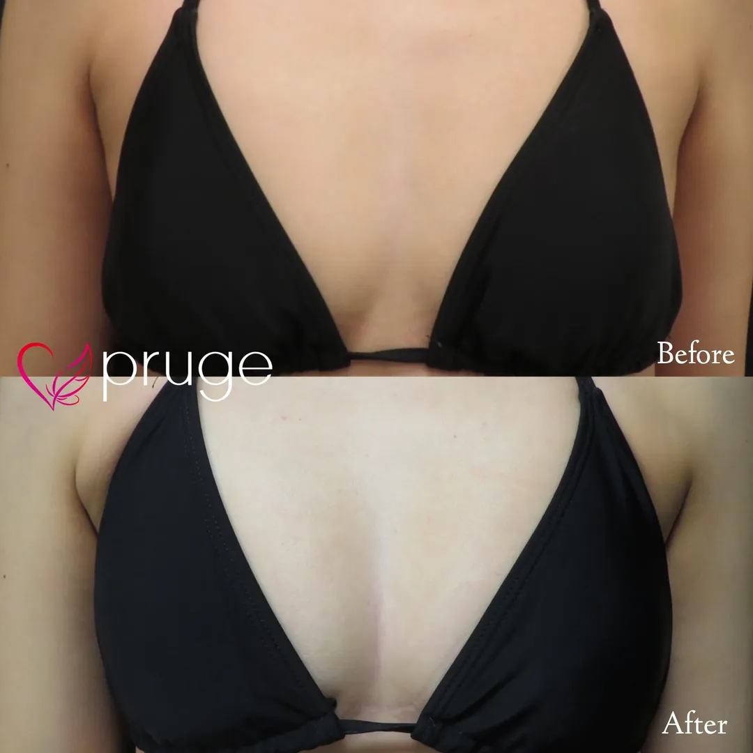 PRP注射（お胸）