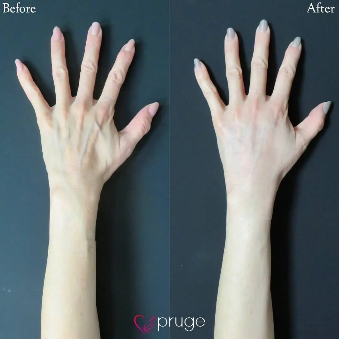 PRP注射（手の甲）