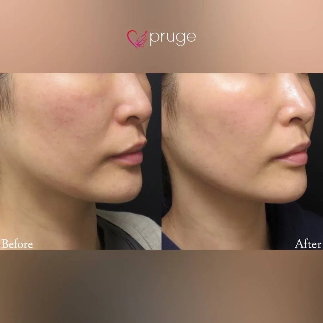 ヴァンパイアフェイシャル（全顔）