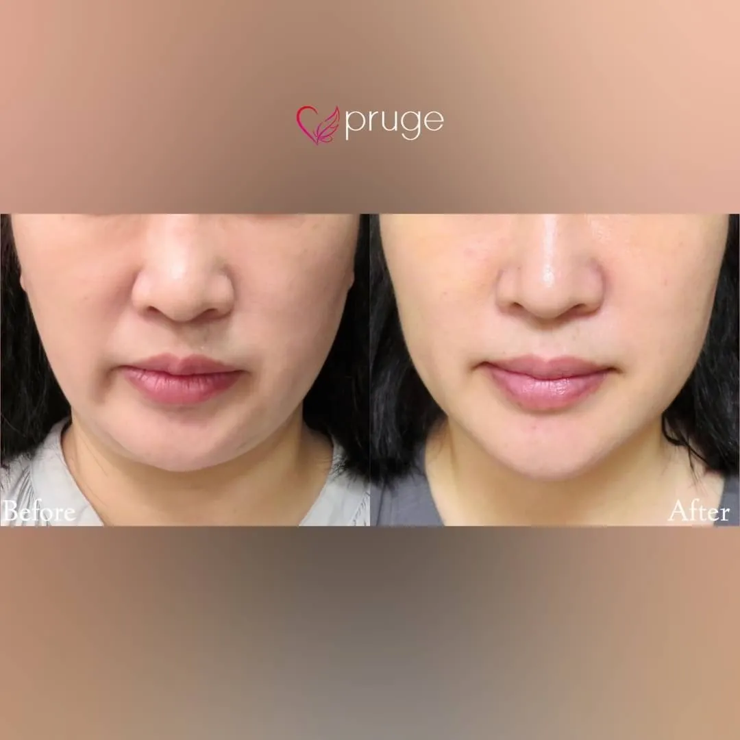 PRP注射（ほうれい線）・pスリム注射（フェイスライン）