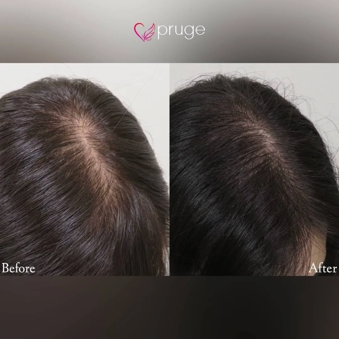 ｐ-スカルプ（1回）