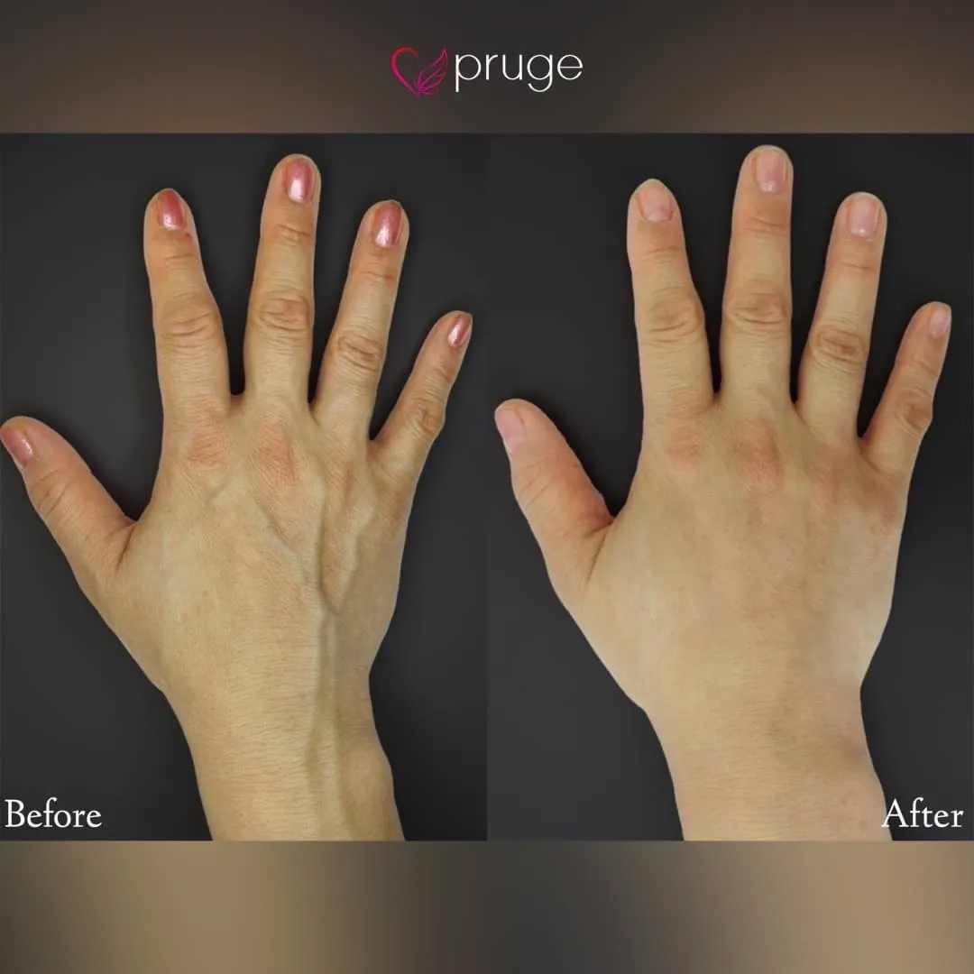 ハンドベイン（レーザー療法）