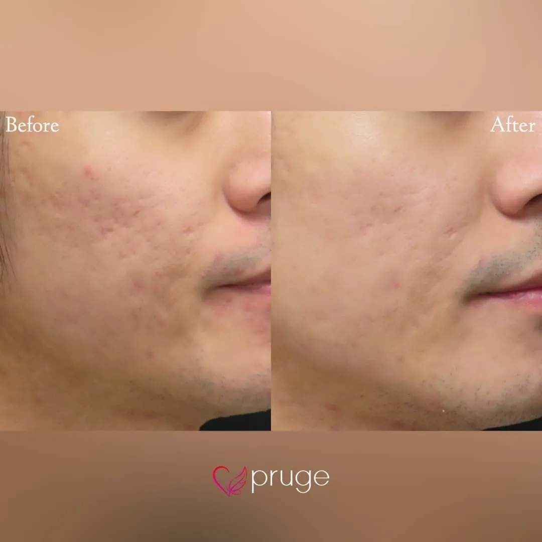 ヴァンパイアフェイシャル（全顔）