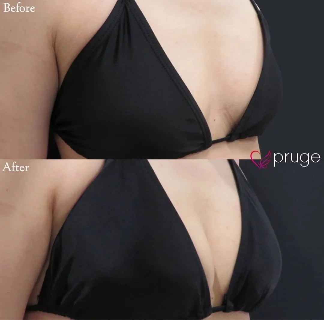 PRP注射（お胸）