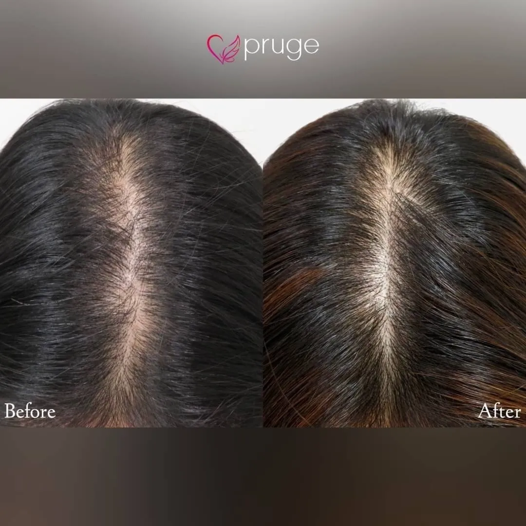 ｐ-スカルプ（3回）