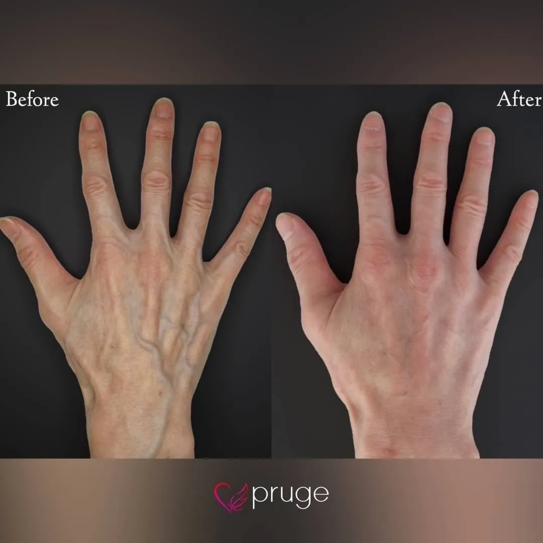 ハンドベイン（レーザー療法）