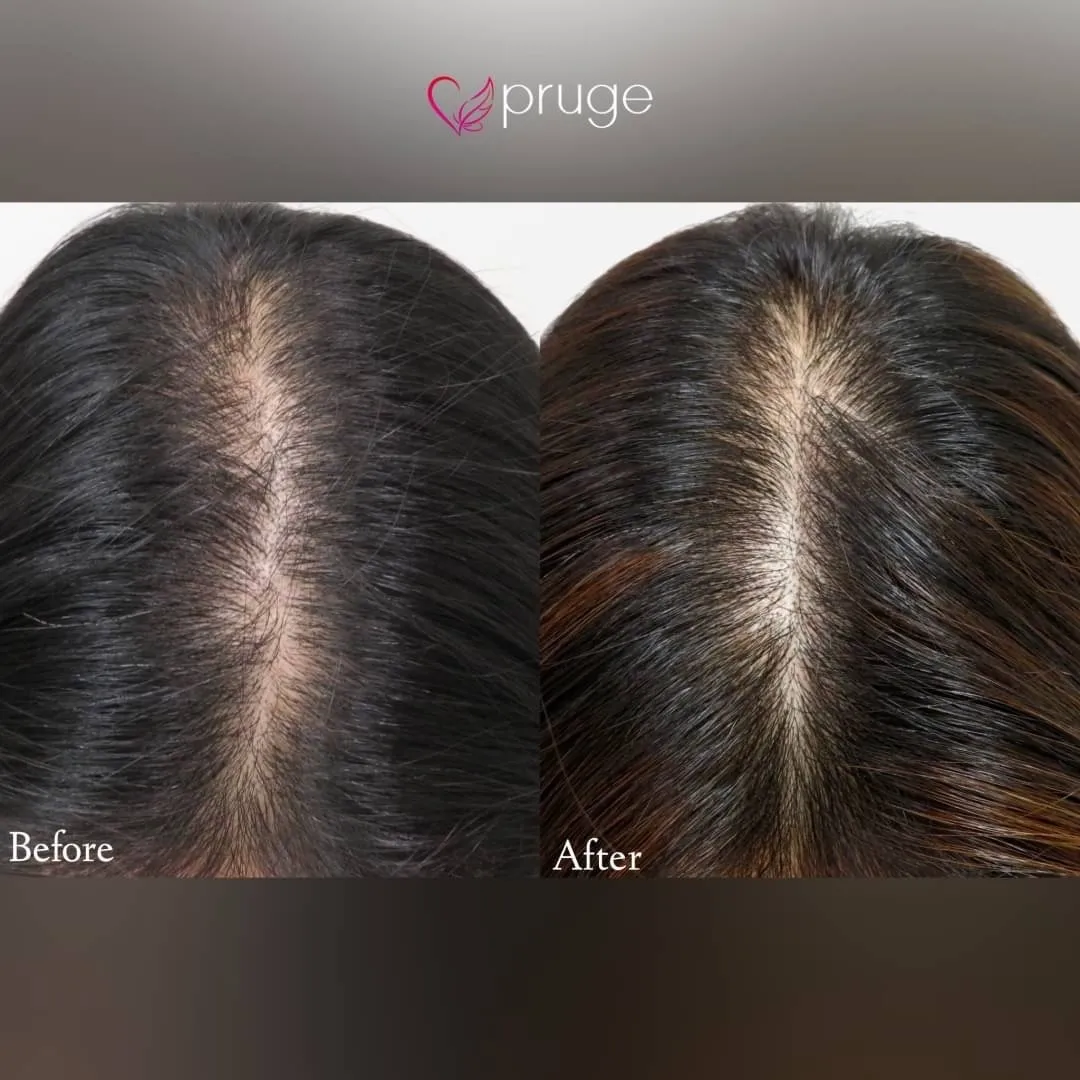 ｐ-スカルプ（3回）