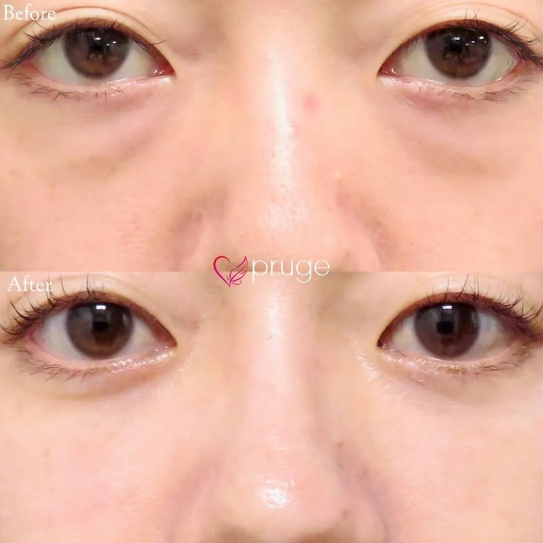 PRP-MI脱脂術(目の下)