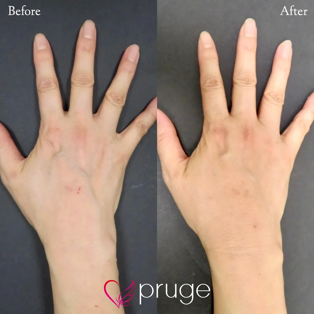 手の血管のボコボコ