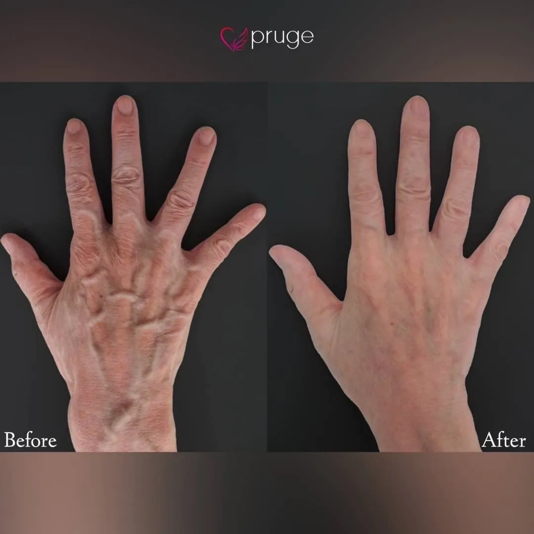 ハンドベイン（レーザー療法）