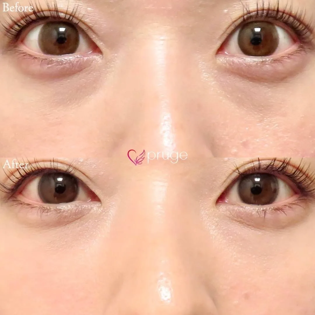 PRP注射（目の下）