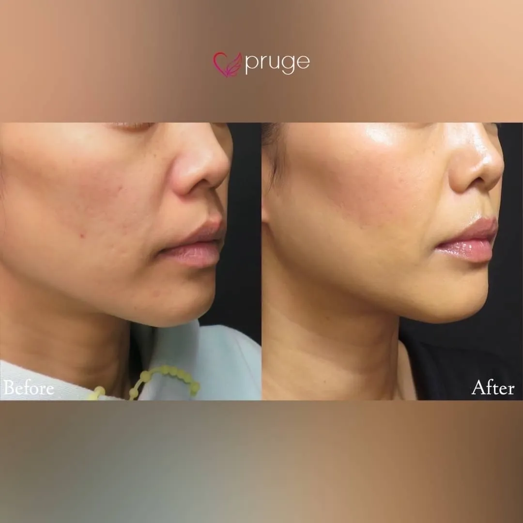 PRPコラーゲンリフト（フェイスライン）60本