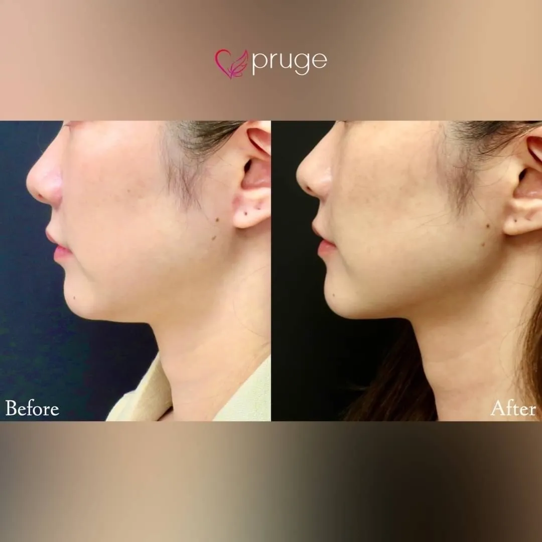 ｐスリム注射（アゴ下）