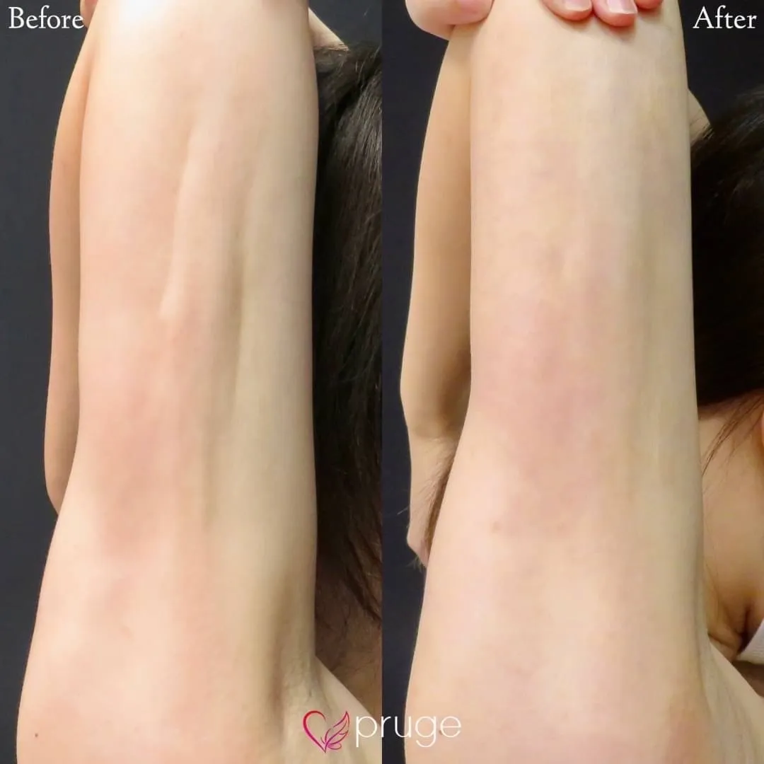 脂肪吸引後修正（二の腕）