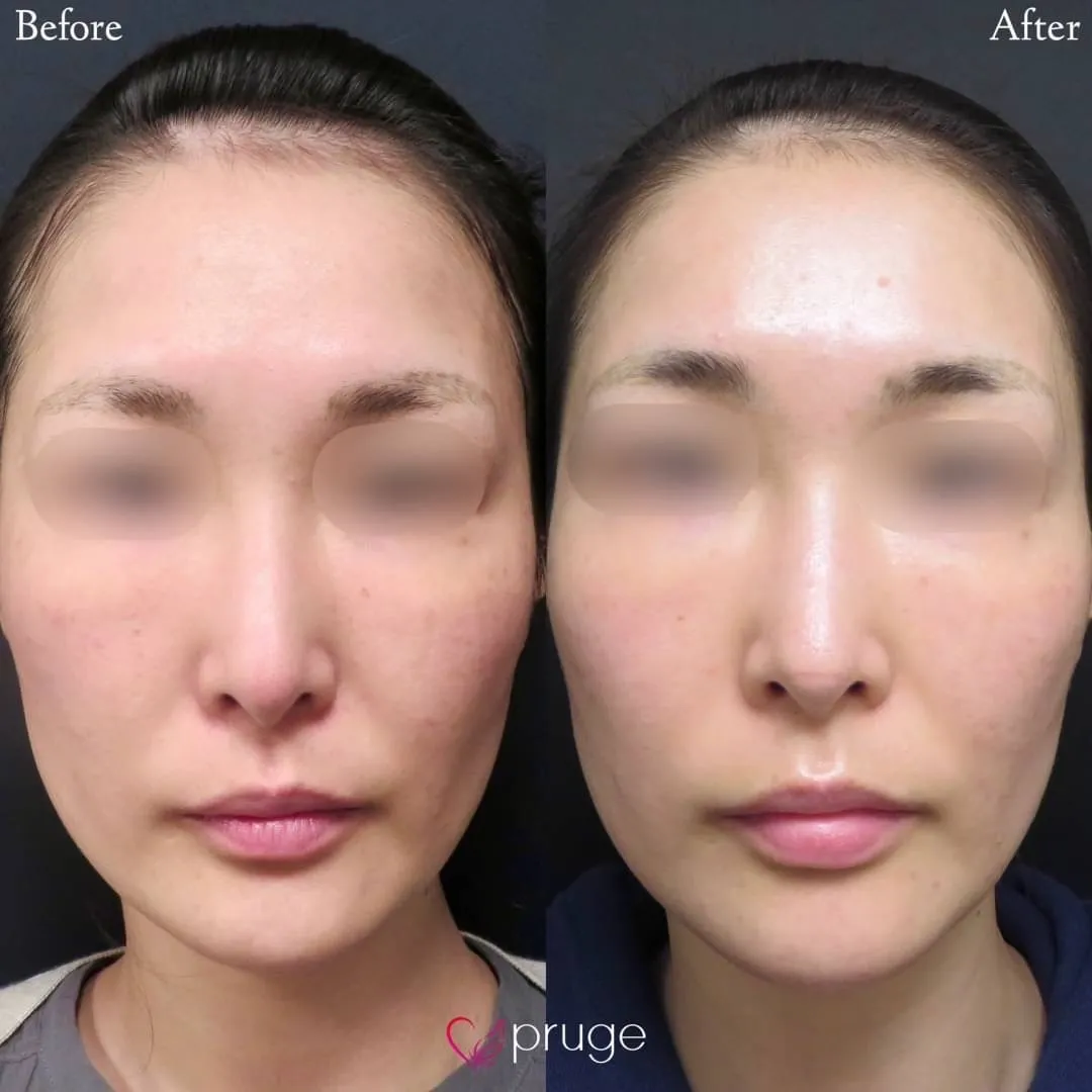 ヴァンパイアフェイシャル（全顔）