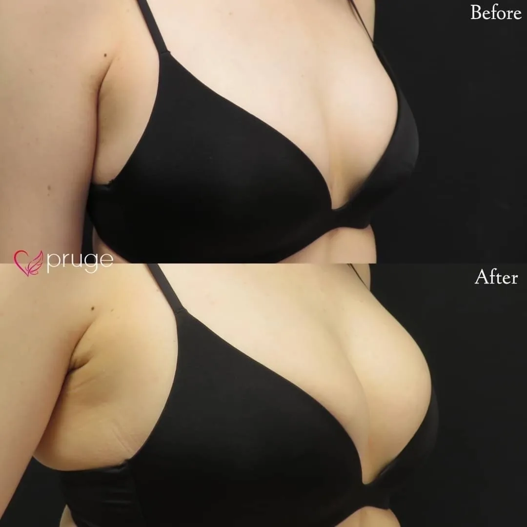 PRP注射（お胸）