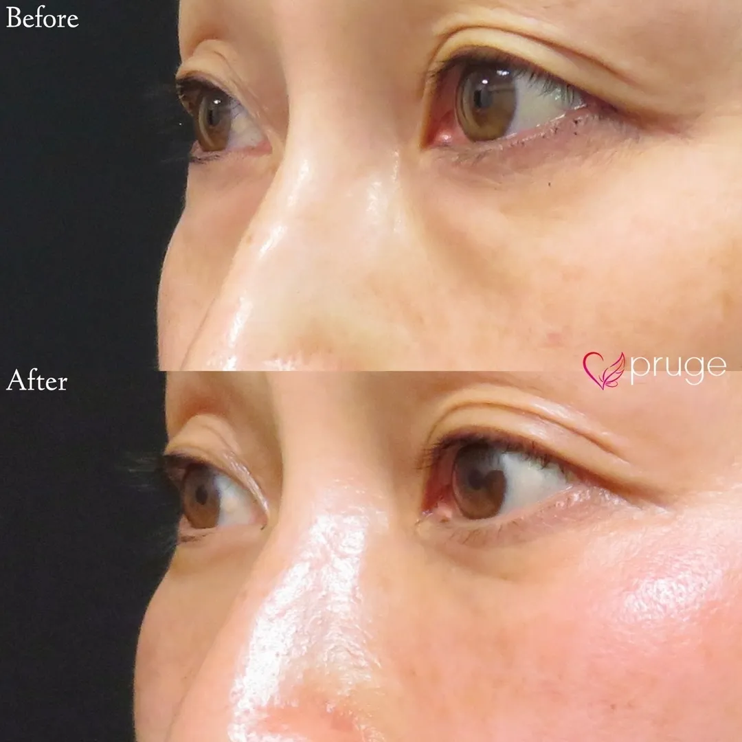 PRP-MI脱脂術（目の下）