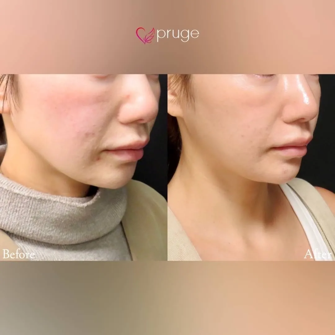 ヴァンパイアフェイシャル（全顔）