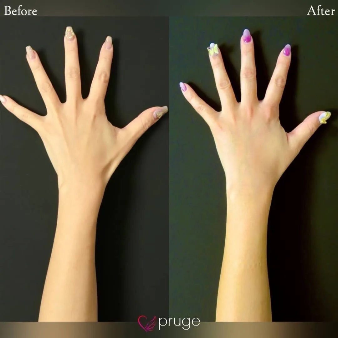 PRP注射（手の甲）