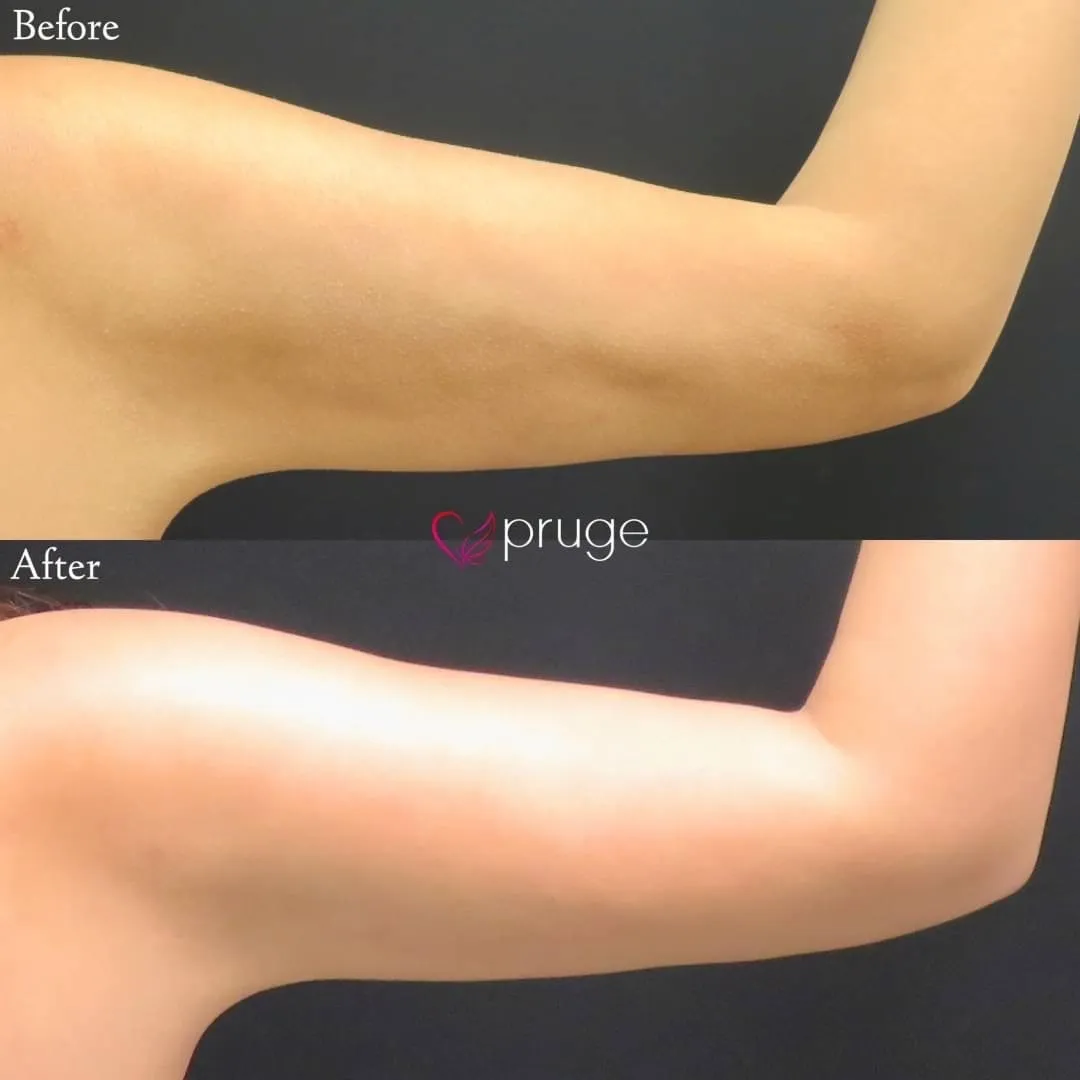 脂肪吸引後修正（二の腕）