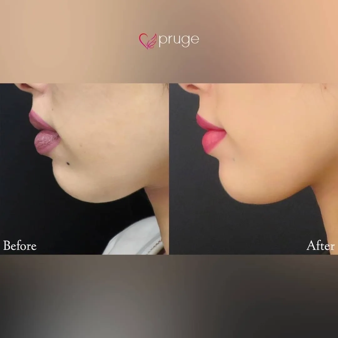 PRP注射（アゴ）