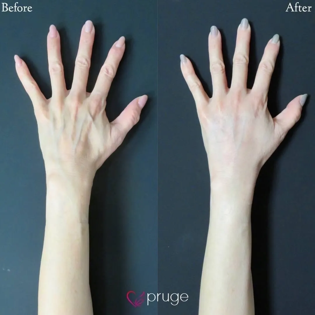 PRP注射（手の甲）＋硬化療法