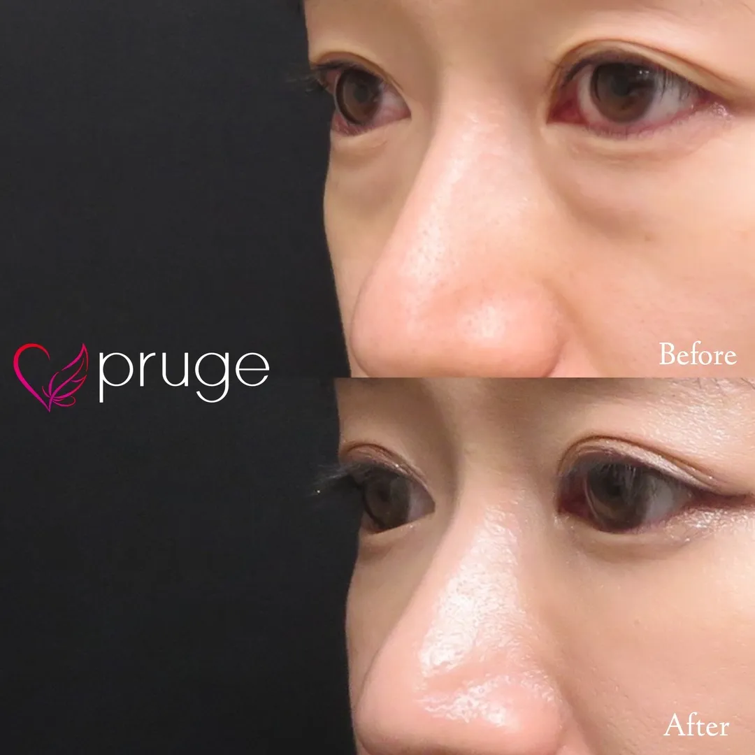 目の下のクマ・ふくらみ