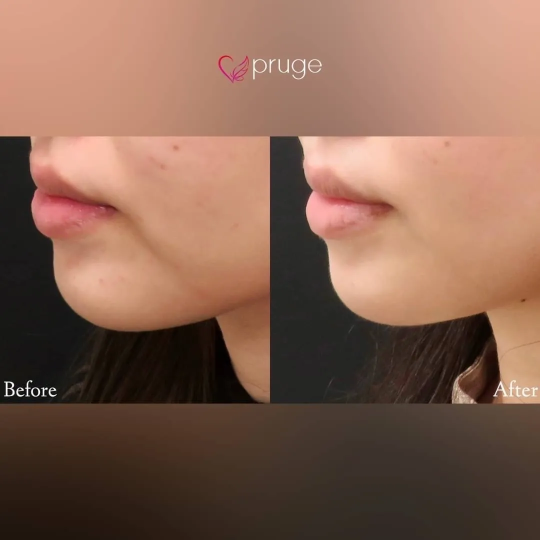 PRP注射（マリオネットライン）