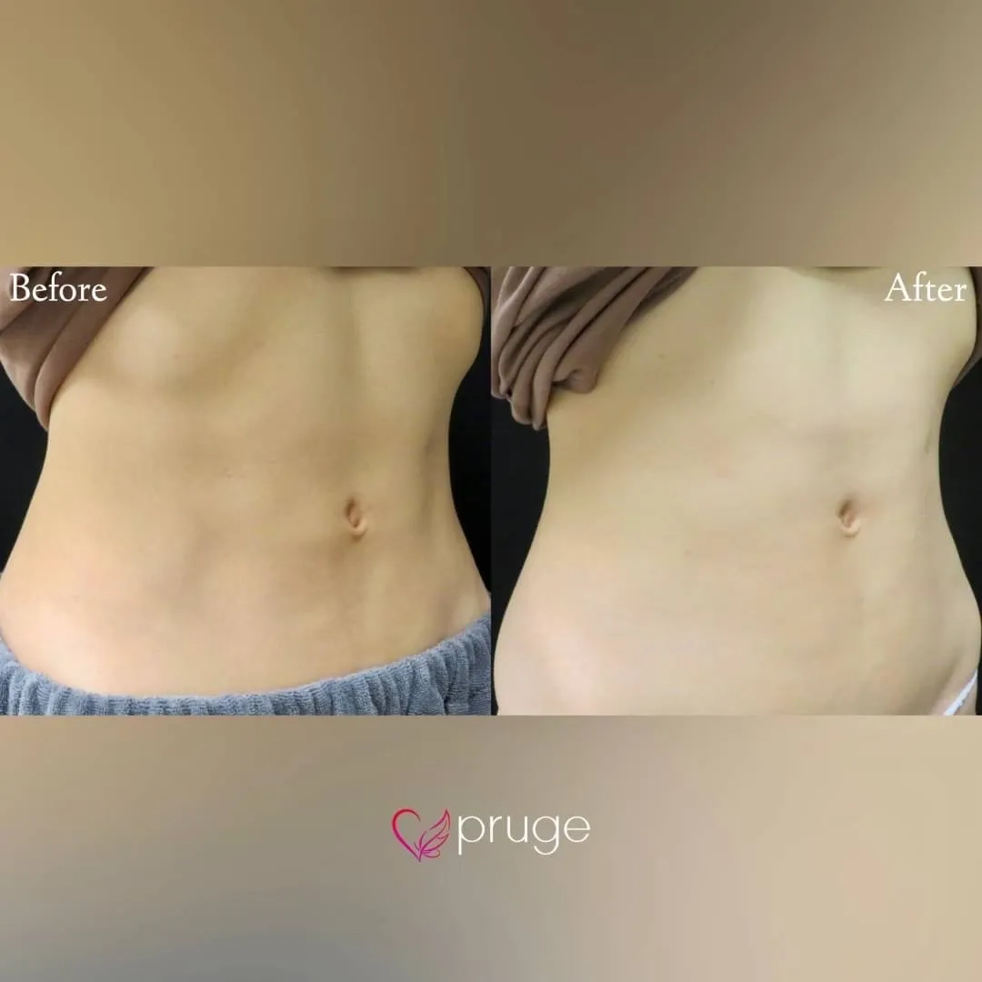 脂肪吸引後修正（お腹）