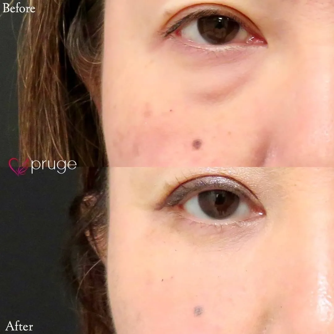 PRP-MI脱脂術（目の下）