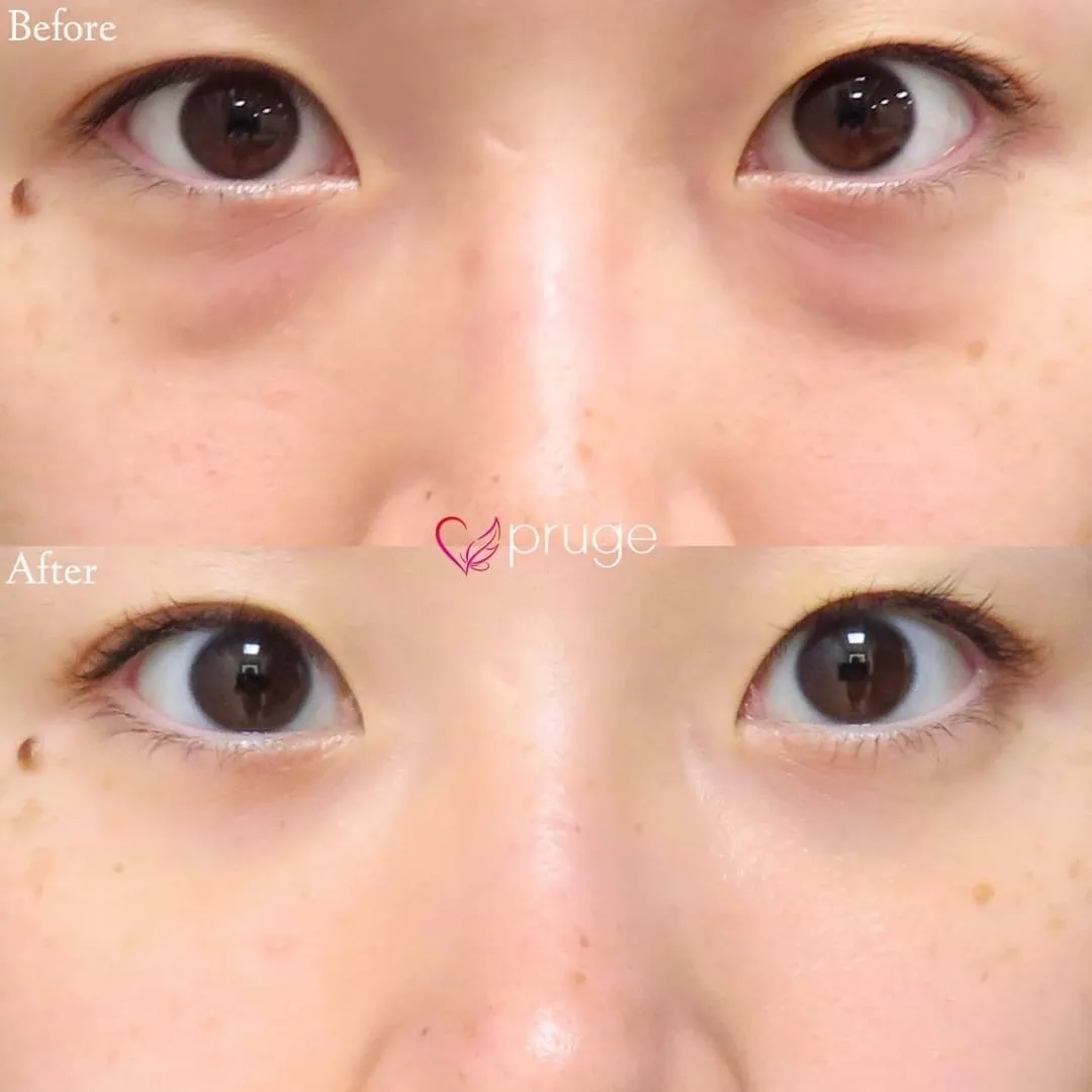 PRP-MI脱脂術（目の下）