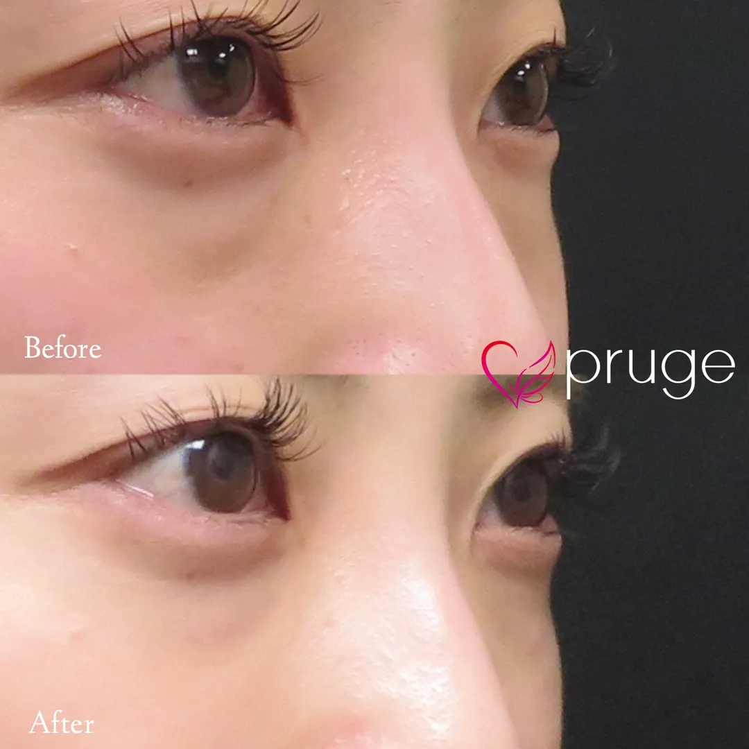 目の下のクマ・ふくらみ