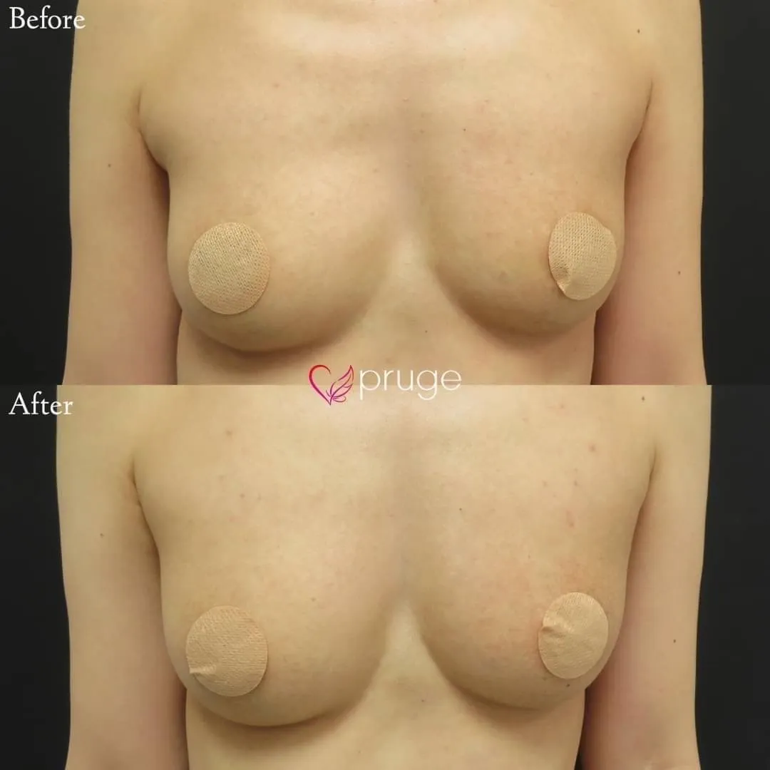 PRP注射によるバストアップ