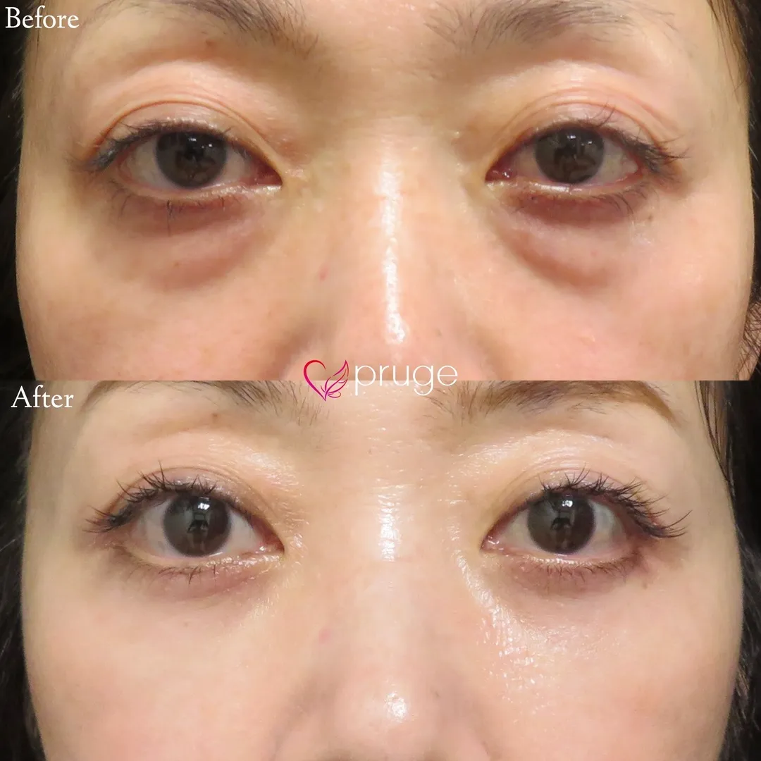 PRP-MI脱脂術アイスプレミアム（目の下）