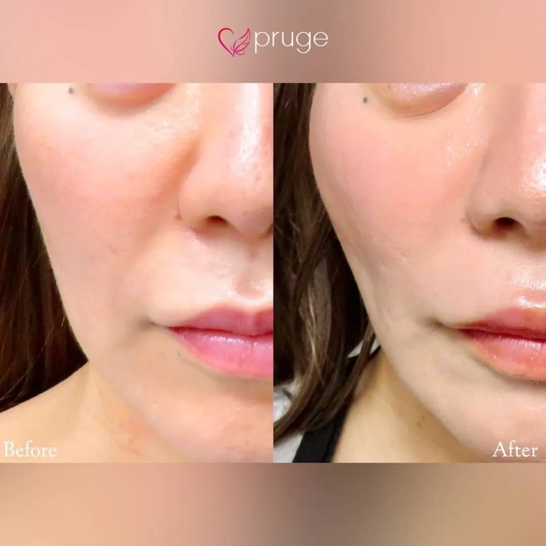 PRP注射（ほうれい線）