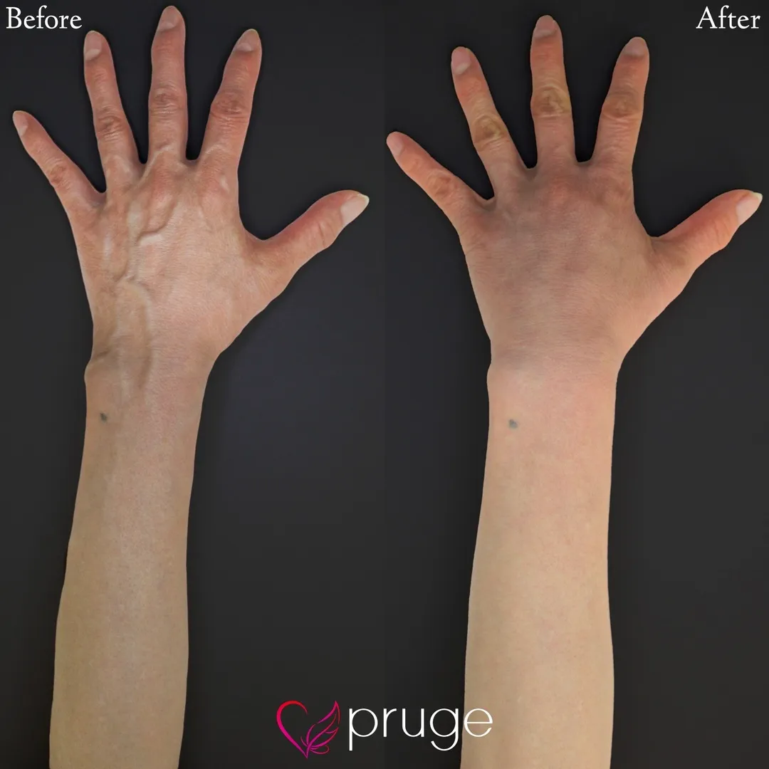 ハンドベイン（レーザー療法）