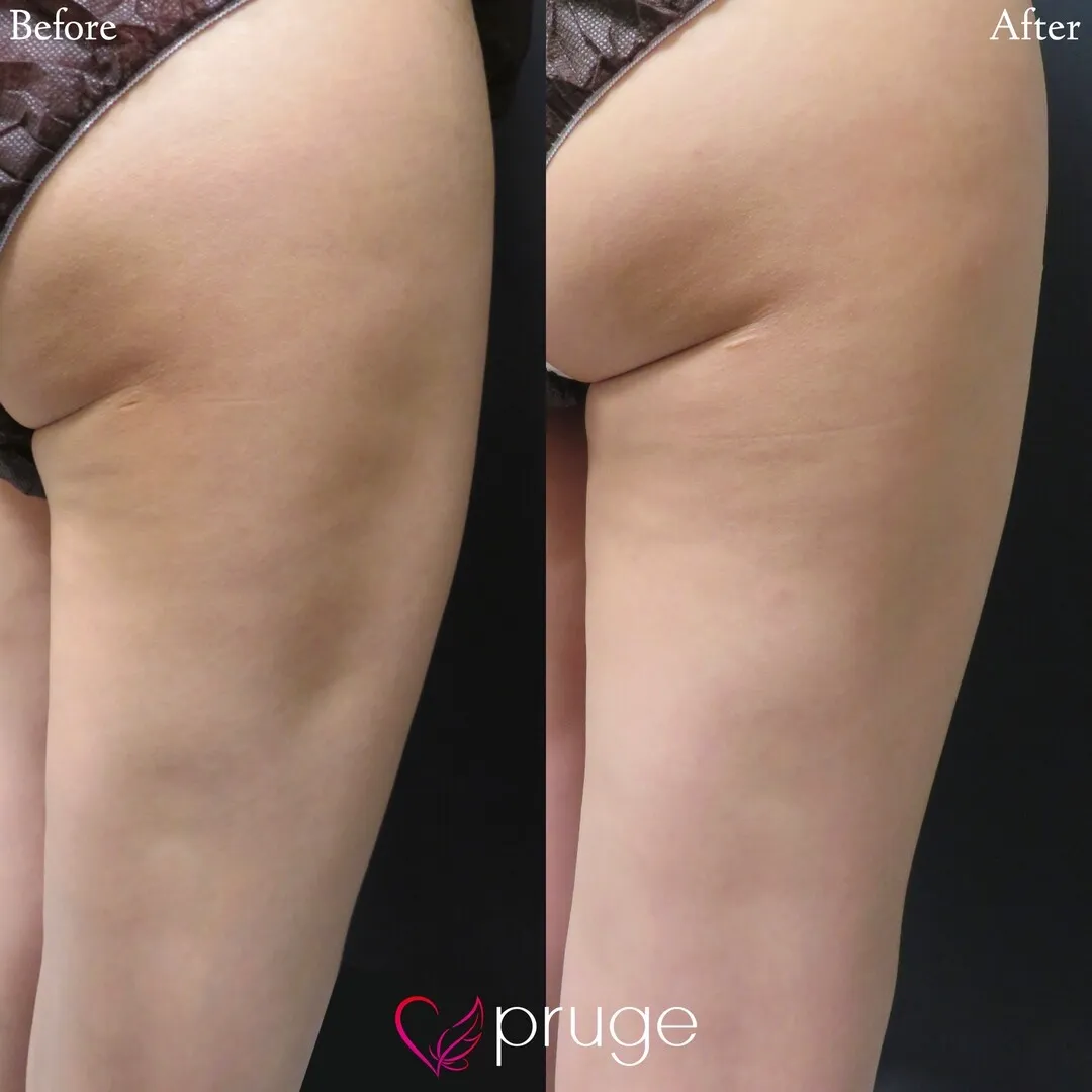 脂肪吸引後修正（太もも）