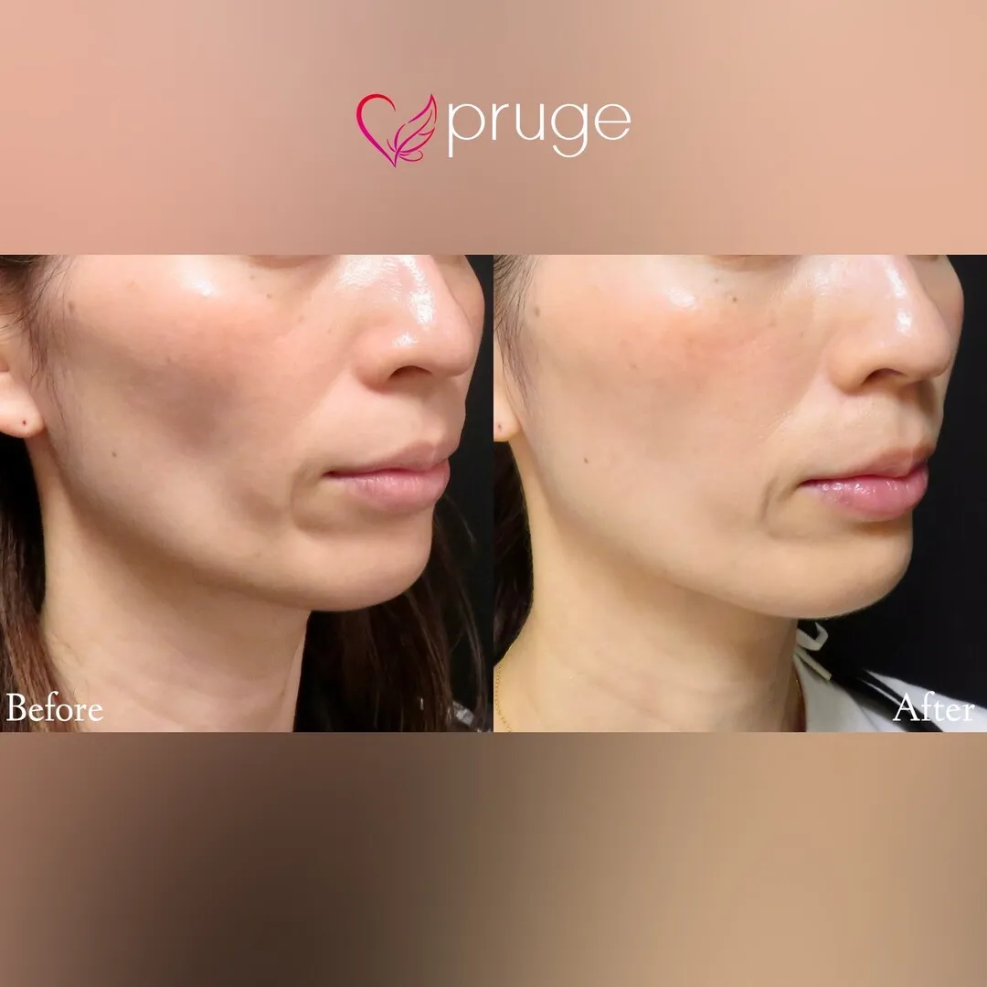 PRP注射（ホホ）