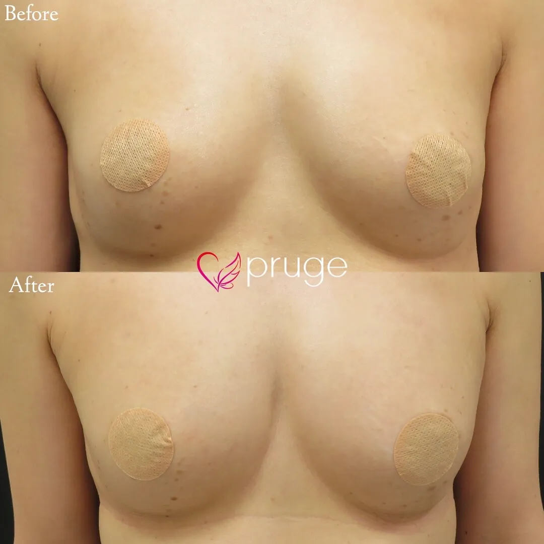 PRP注射によるバストアップ