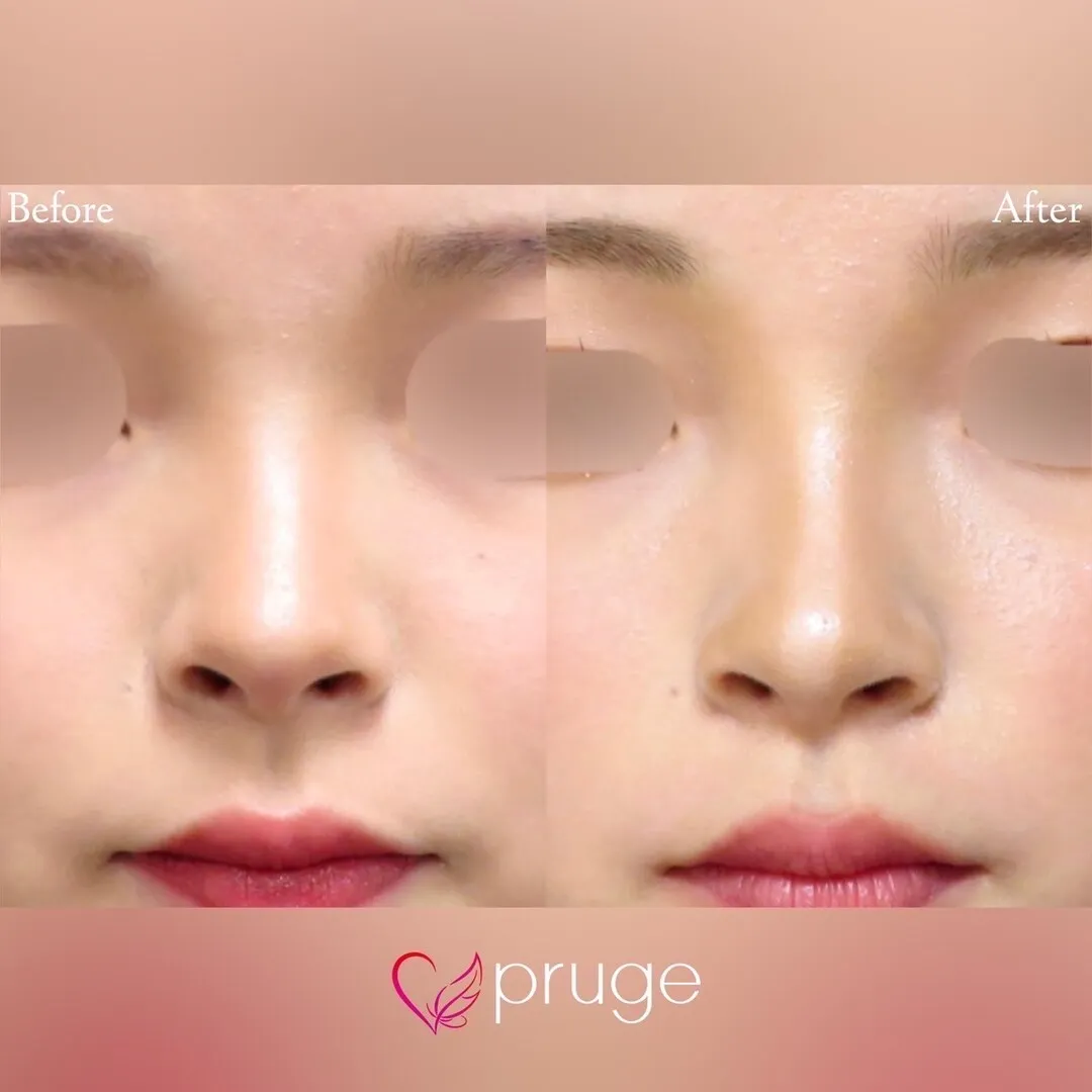 PRP注射（鼻尖・鼻根・鼻孔）