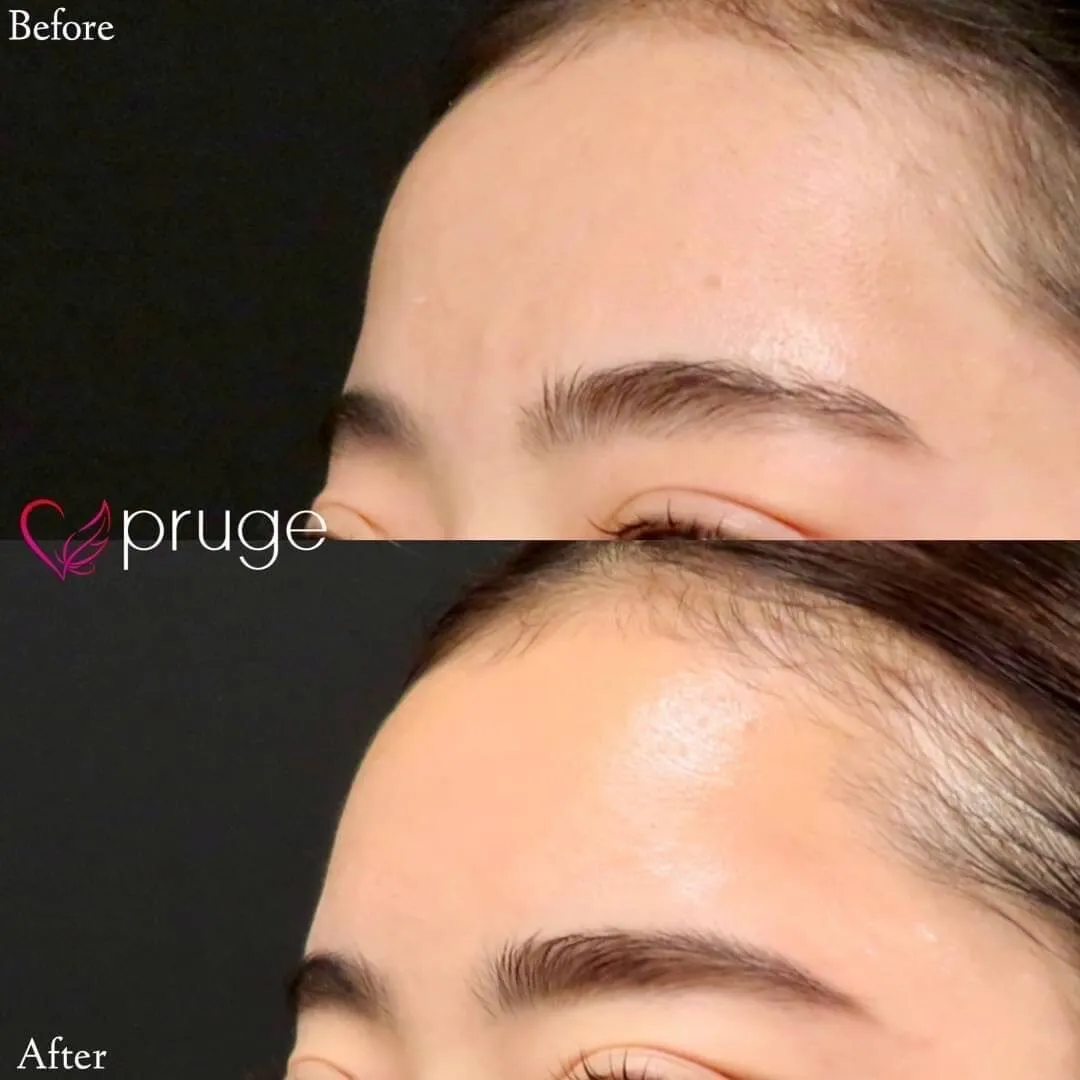 PRP注射(ひたい・こめかみ丸み形成)