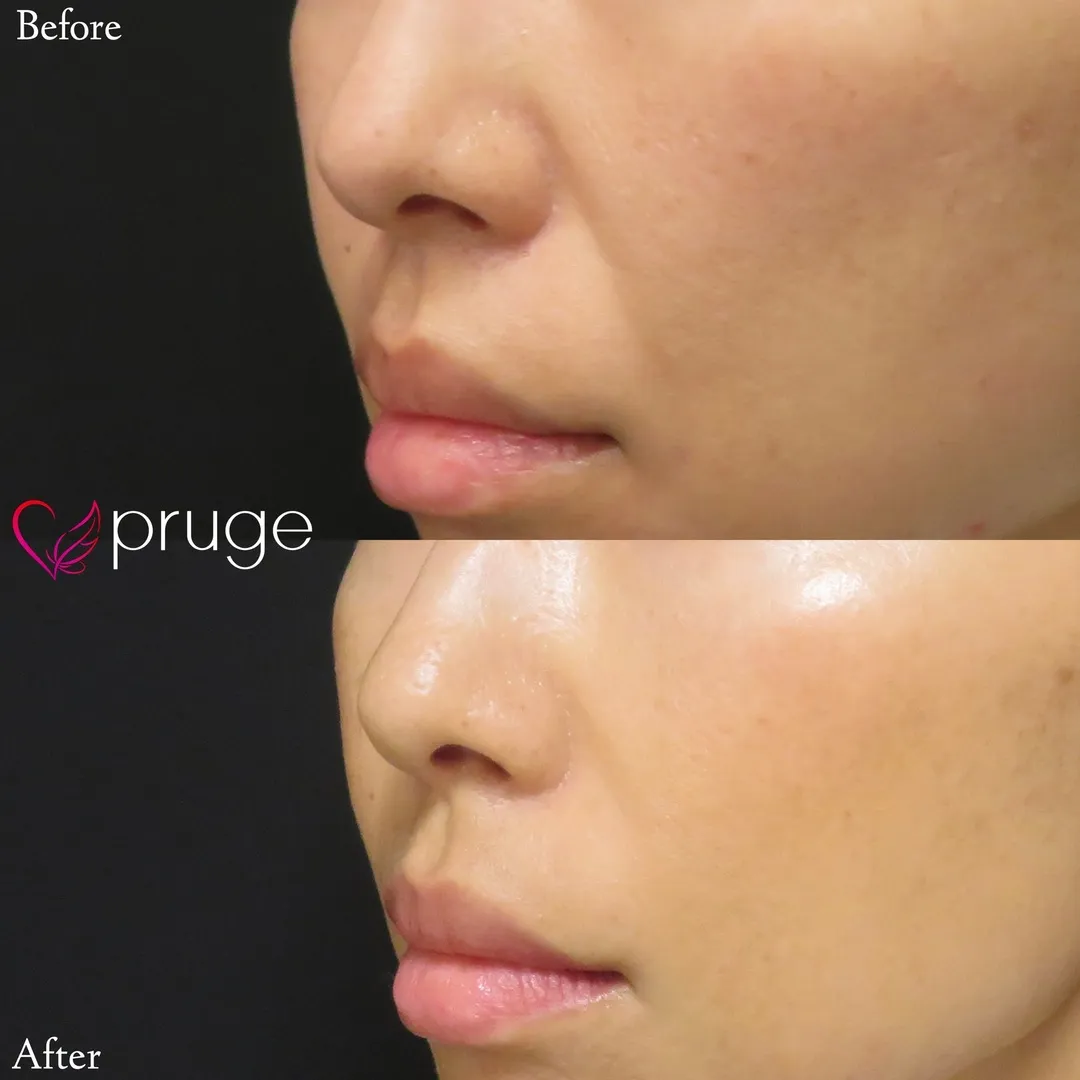 PRP注射（ほうれい線）