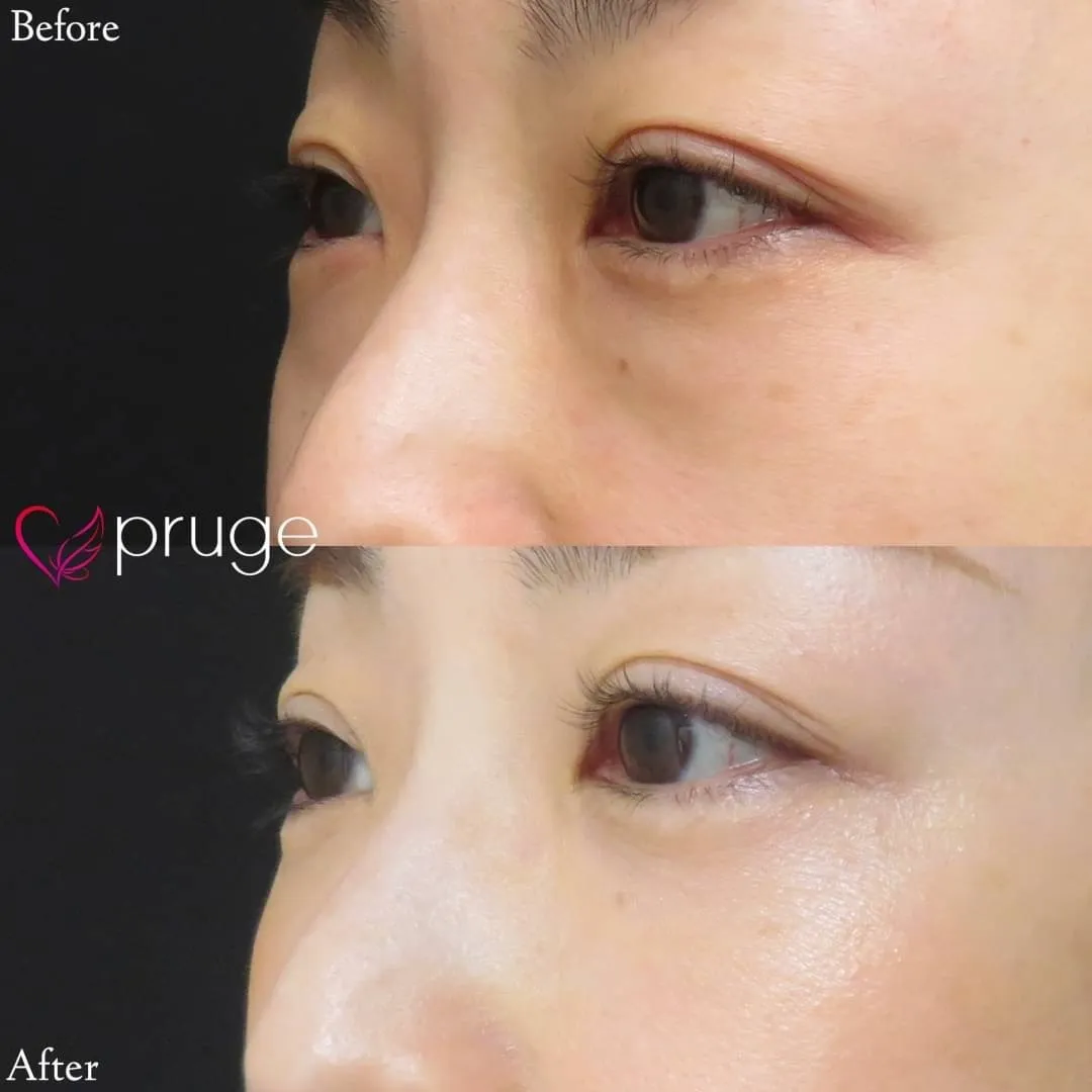 PRP-MI脱脂術・PRP注射（目頭）