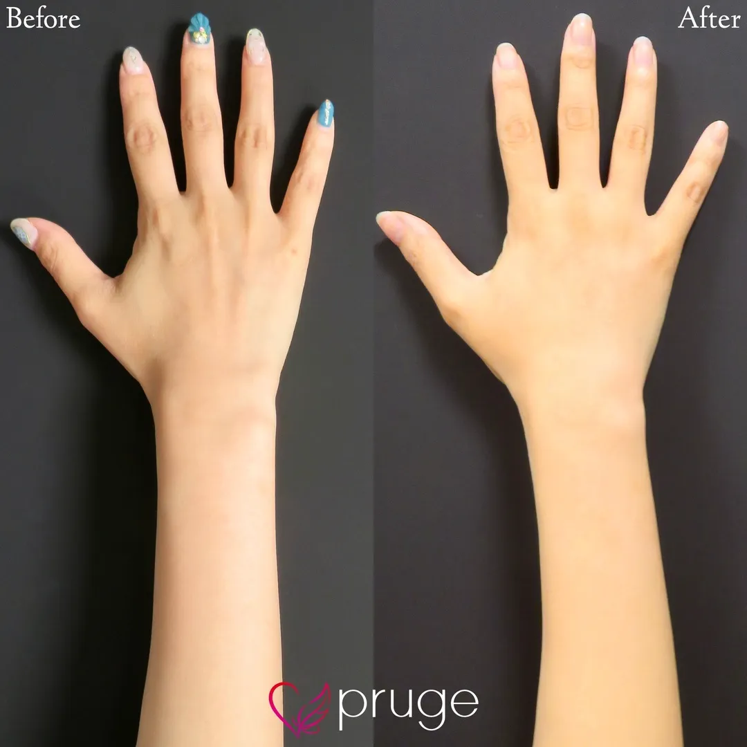 PRP注射（手の甲）