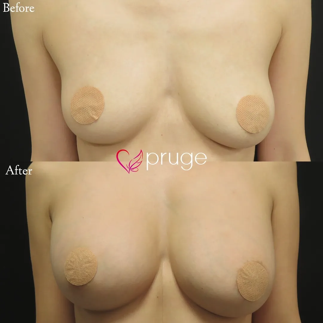 PRP注射とヒアルロン酸によるバストアップ