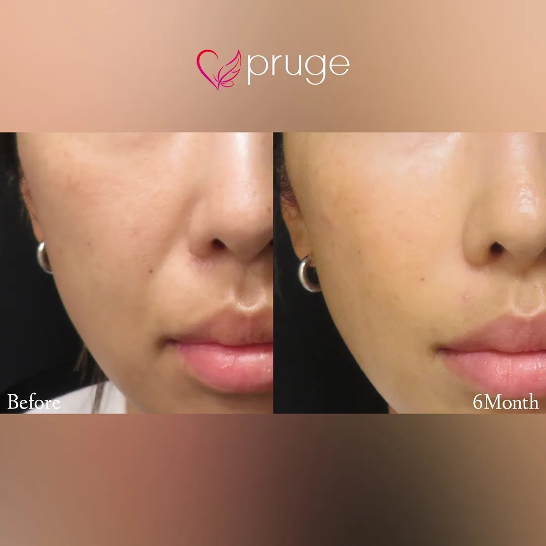 PRP注射（ほうれい線）