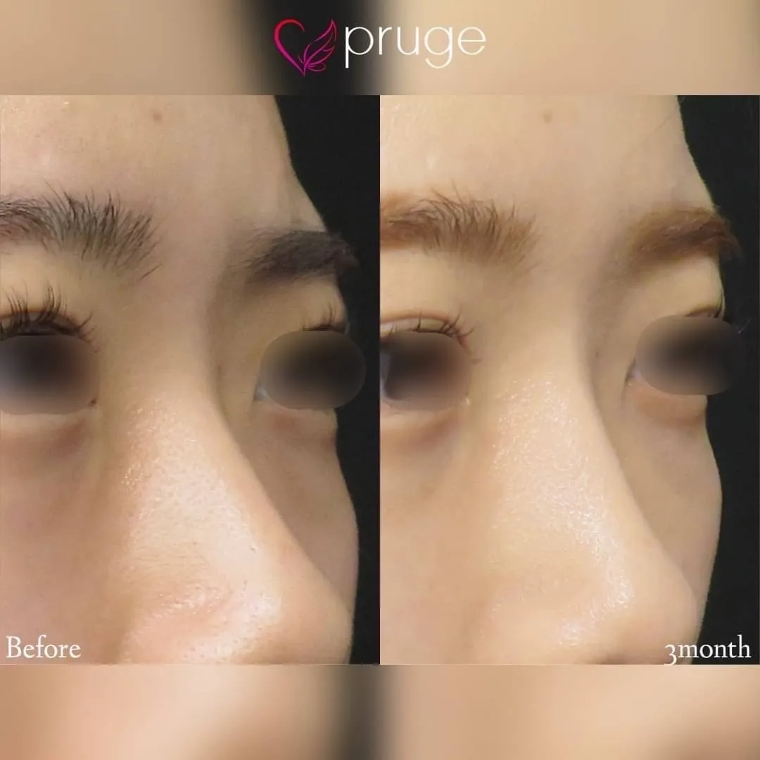 PRP注射（鼻根）